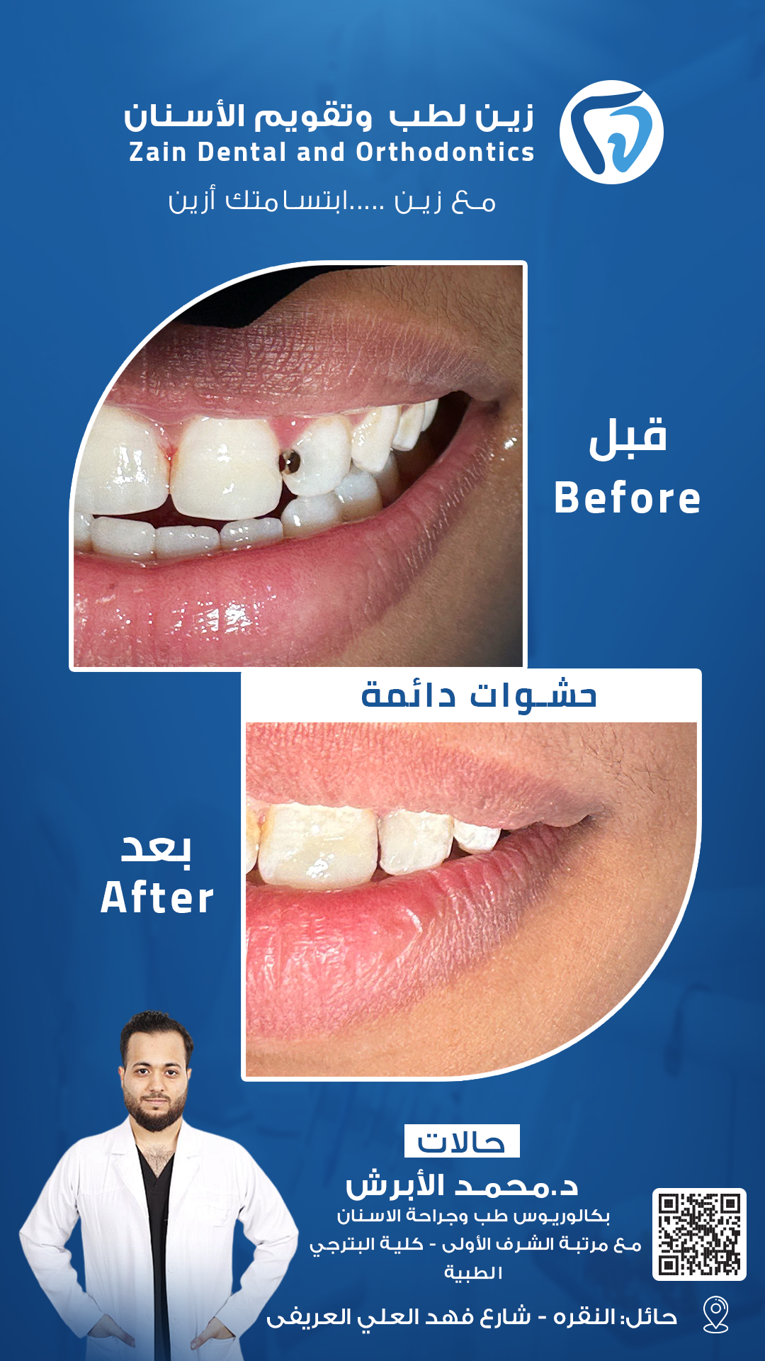 قبل وبعد د ابرش copy9