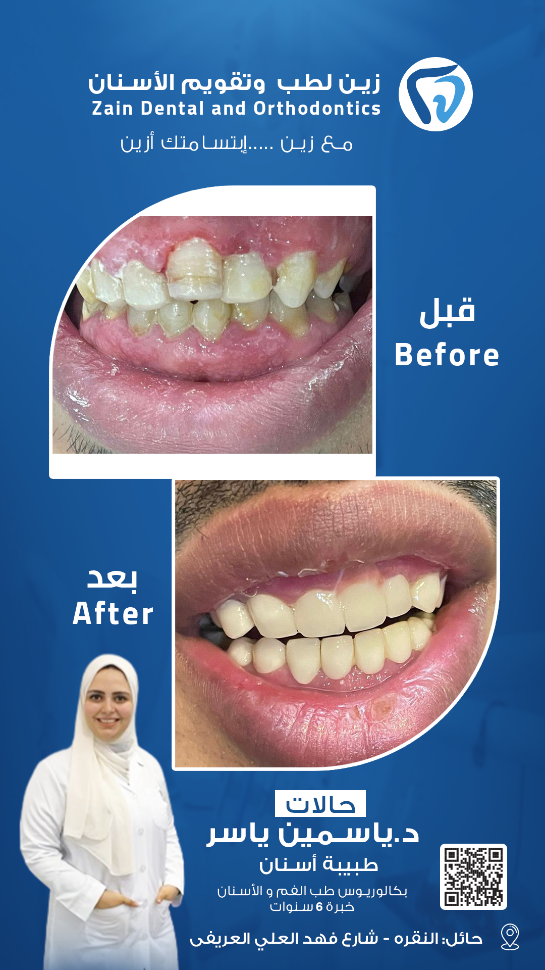 قبل وبعد د ياسمين 5 0.2