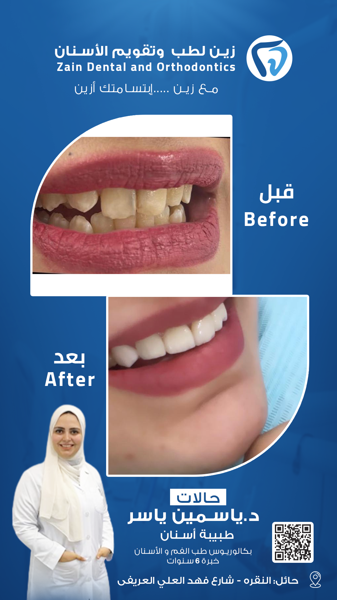 قبل وبعد د ياسمين 5 0.3